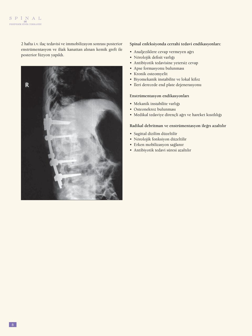 osteomyelit Biyomekanik instabilite ve lokal kifoz İleri derecede end plate dejenerasyonu Enstrümentasyon endikasyonları Mekanik instabilite varlığı Osteonekroz bulunması Medikal