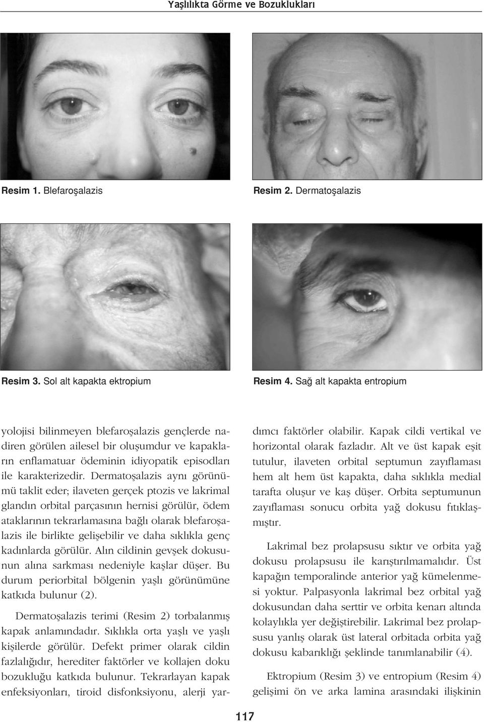 Dermatoflalazis ayn görünümü taklit eder; ilaveten gerçek ptozis ve lakrimal gland n orbital parças n n hernisi görülür, ödem ataklar n n tekrarlamas na ba l olarak blefaroflalazis ile birlikte