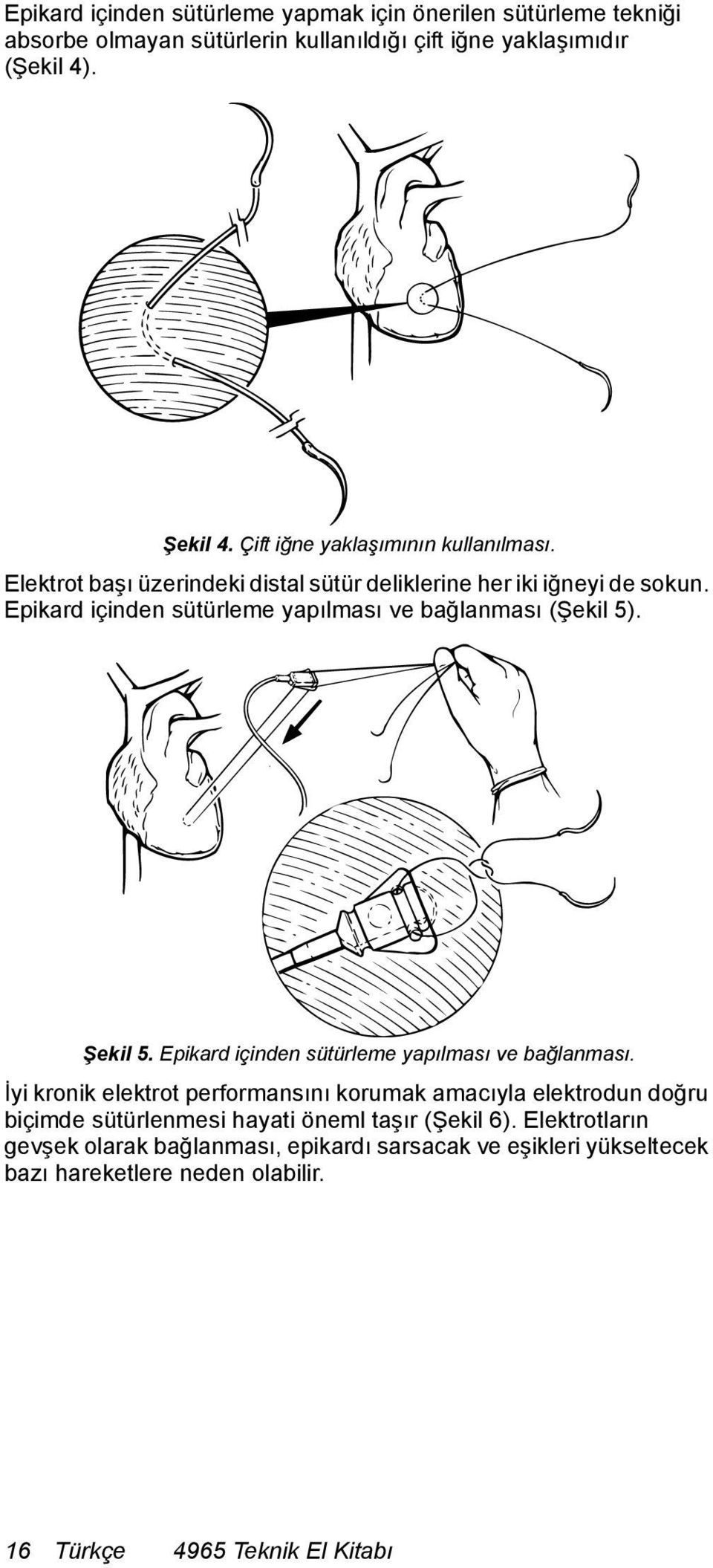 Epikard içinden sütürleme yapılması ve bağlanması (Şekil 5). Şekil 5. Epikard içinden sütürleme yapılması ve bağlanması.