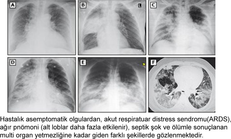 fazla etkilenir), septik şok ve ölümle sonuçlanan multi