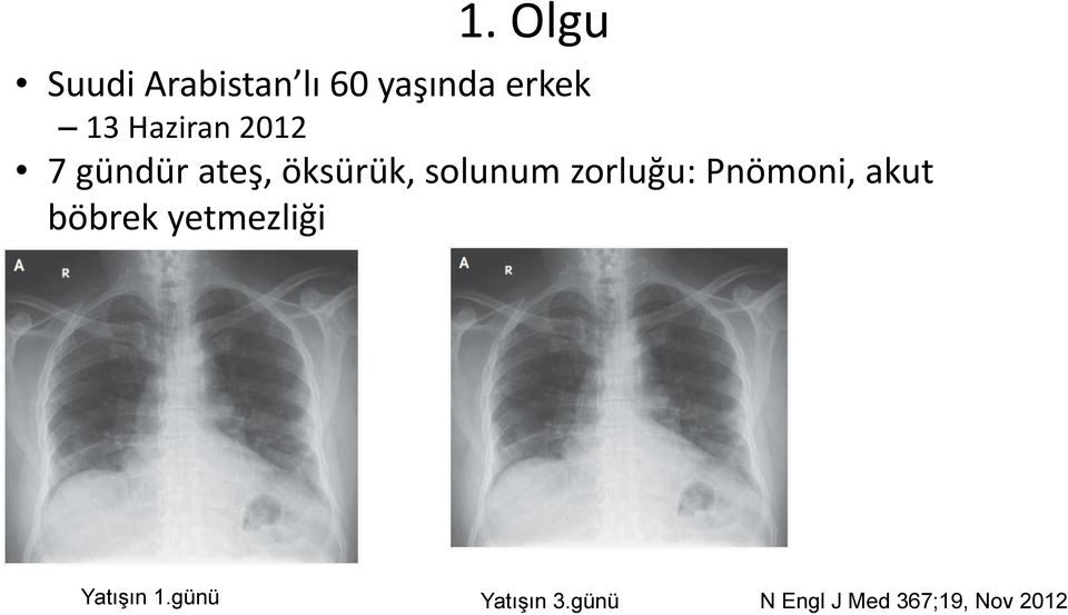 zorluğu: Pnömoni, akut böbrek yetmezliği