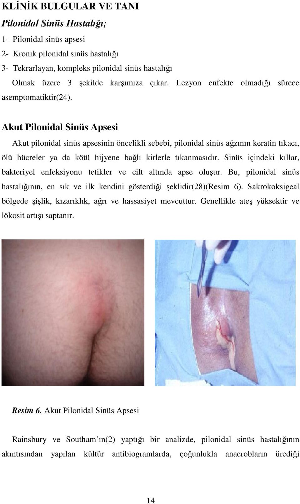 Akut Pilonidal Sinüs Apsesi Akut pilonidal sinüs apsesinin öncelikli sebebi, pilonidal sinüs ağzının keratin tıkacı, ölü hücreler ya da kötü hijyene bağlı kirlerle tıkanmasıdır.