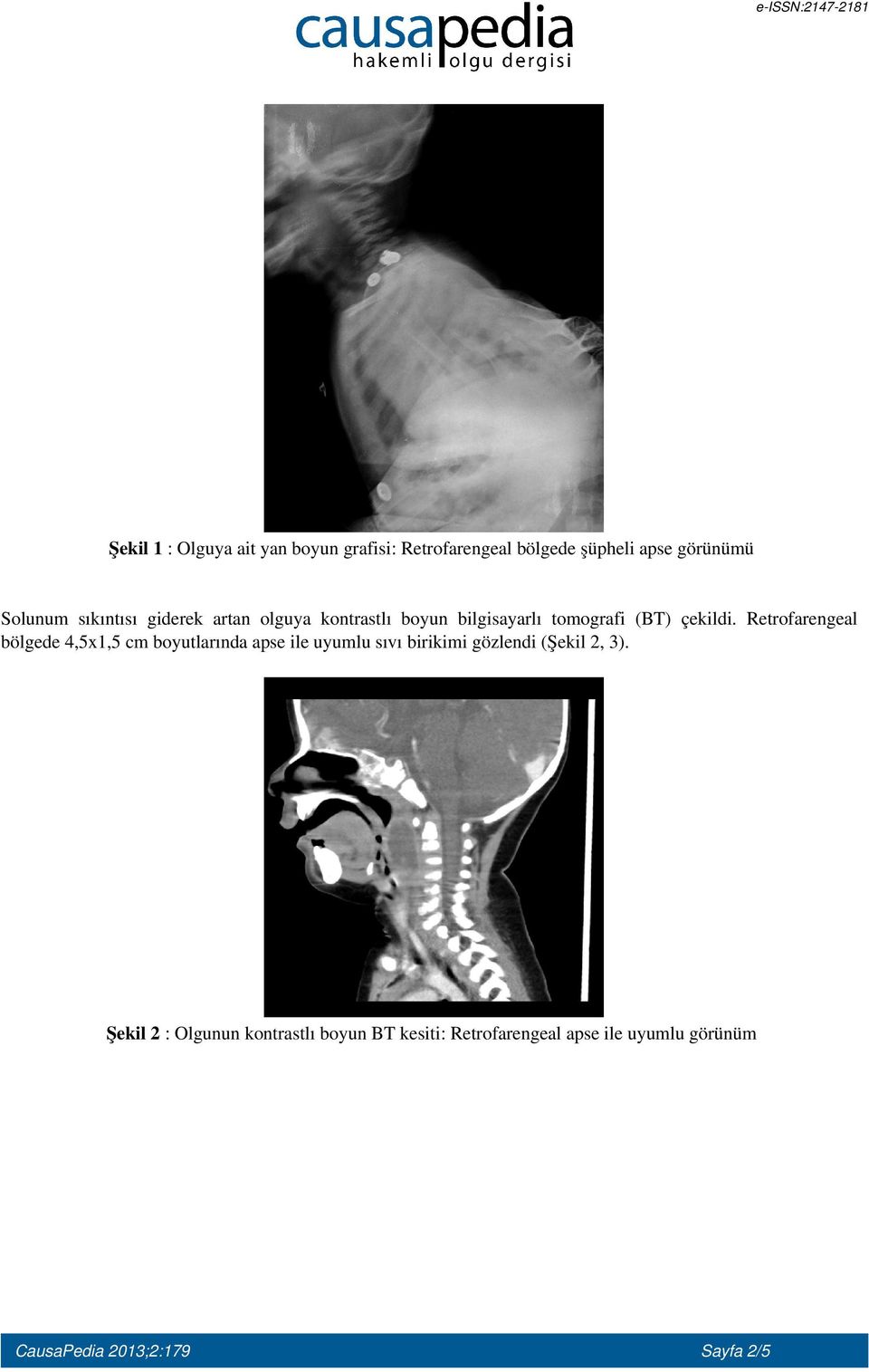 Retrofarengeal bölgede 4,5x1,5 cm boyutlarında apse ile uyumlu sıvı birikimi gözlendi (Şekil 2, 3).