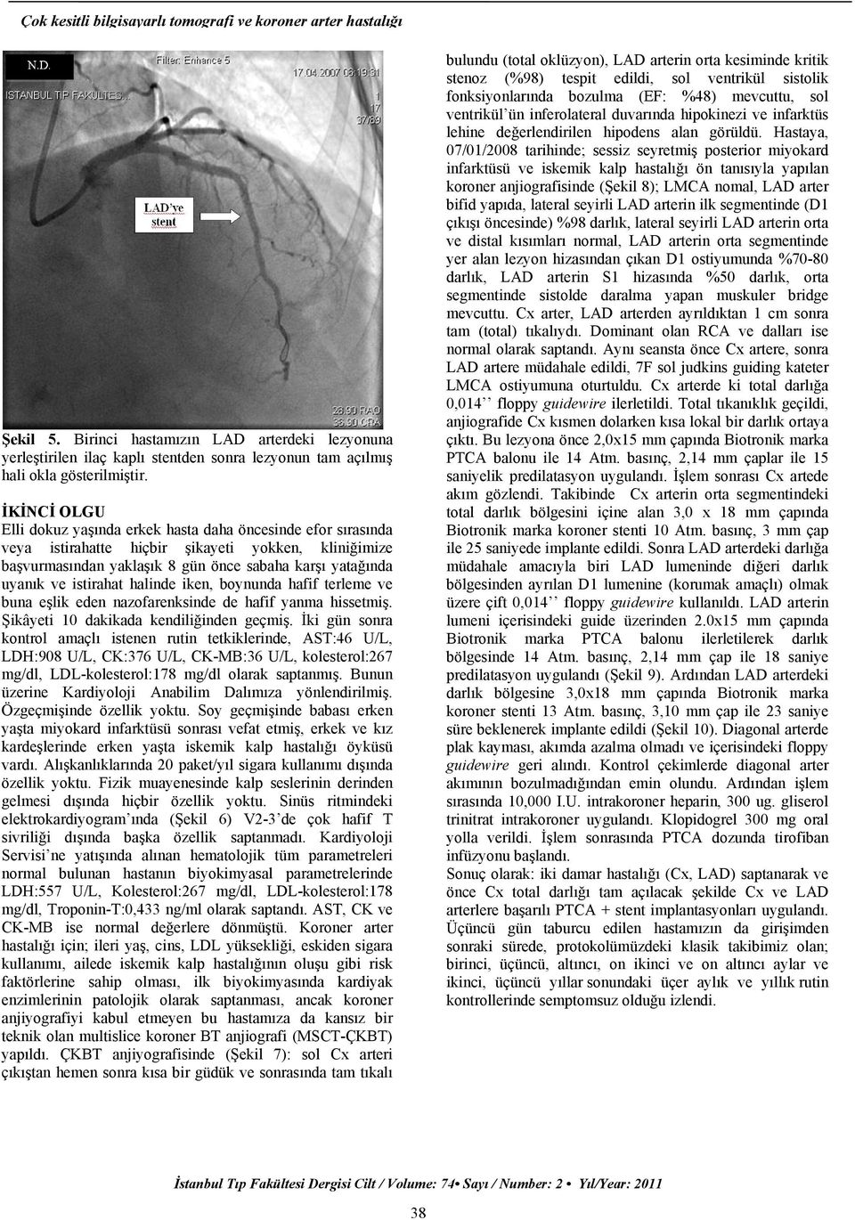 İKİNCİ OLGU Elli dokuz yaşında erkek hasta daha öncesinde efor sırasında veya istirahatte hiçbir şikayeti yokken, kliniğimize başvurmasından yaklaşık 8 gün önce sabaha karşı yatağında uyanık ve