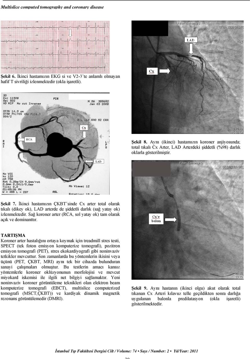 İkinci hastamızın ÇKBT sinde Cx arter total olarak tıkalı (dikey ok), LAD arterde de şiddetli darlık (sağ yatay ok) izlenmektedir. Sağ koroner arter (RCA, sol yatay ok) tam olarak açık ve dominanttır.