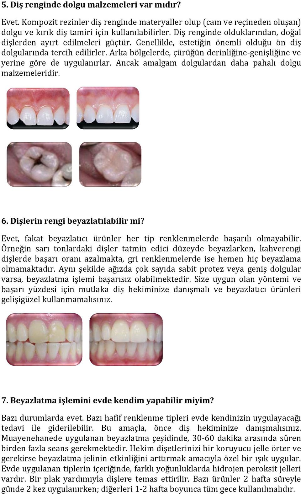 Arka bölgelerde, çürüğün derinliğine genişliğine ve yerine göre de uygulanırlar. Ancak amalgam dolgulardan daha pahalı dolgu malzemeleridir. 6. Diş lerin rengi beyazlatılabilir mi?