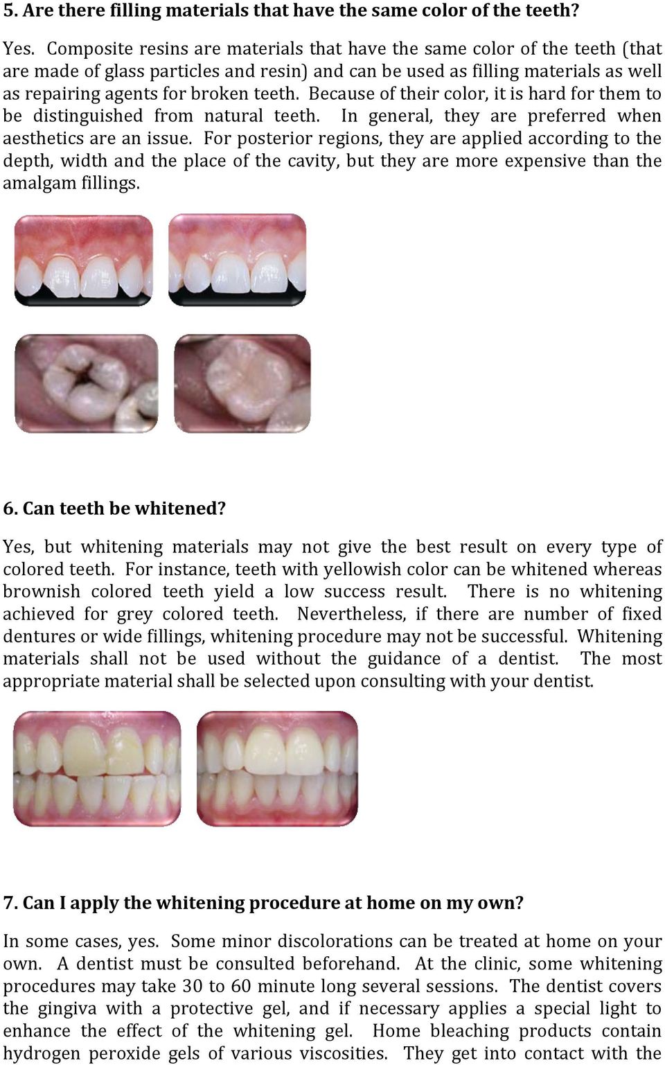 Because of their color, it is hard for them to be distinguished from natural teeth. In general, they are preferred when aesthetics are an issue.