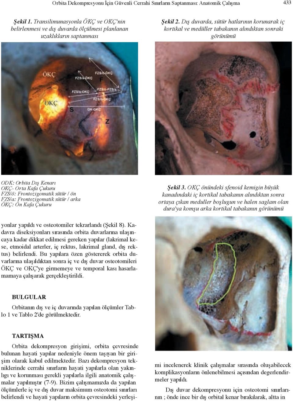 D fl duvarda, sütür hatlar n n korunarak iç kortikal ve medüller tabakan n al nd ktan sonraki görünümü ODK: Orbita D fl Kenar OKÇ- Orta Kafa Çukuru FZS/ö: Frontozigomatik sütür / ön FZS/a: