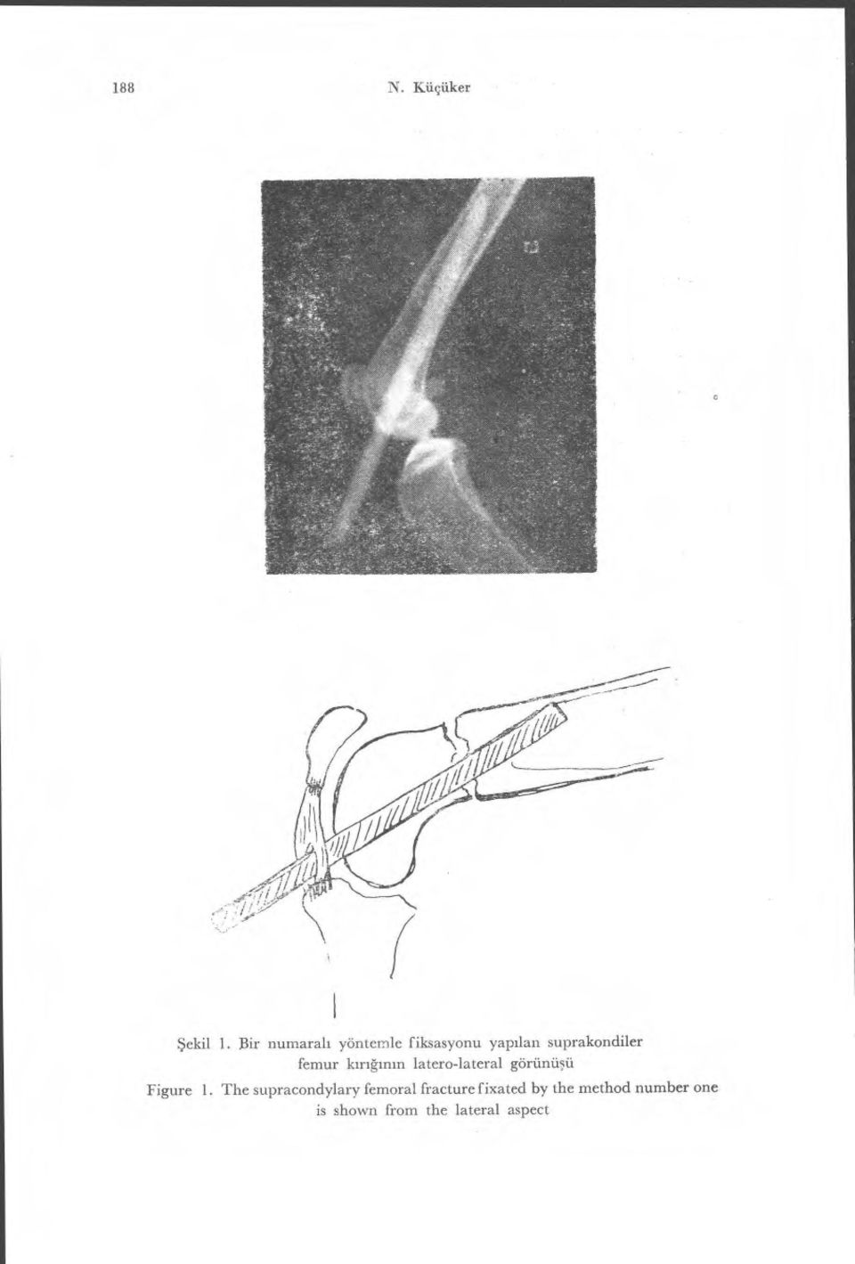 femur k ırığın ın latero-lateral görünü şü Figure 1.