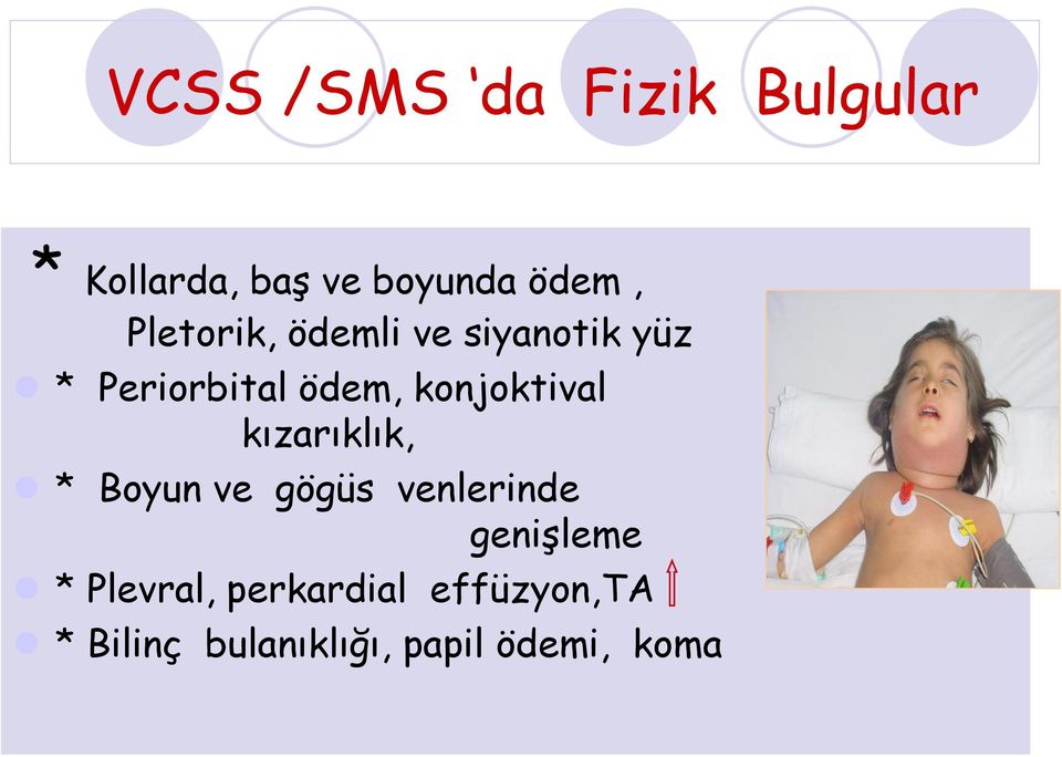 konjoktival kızarıklık, * Boyun ve gögüs venlerinde genişleme