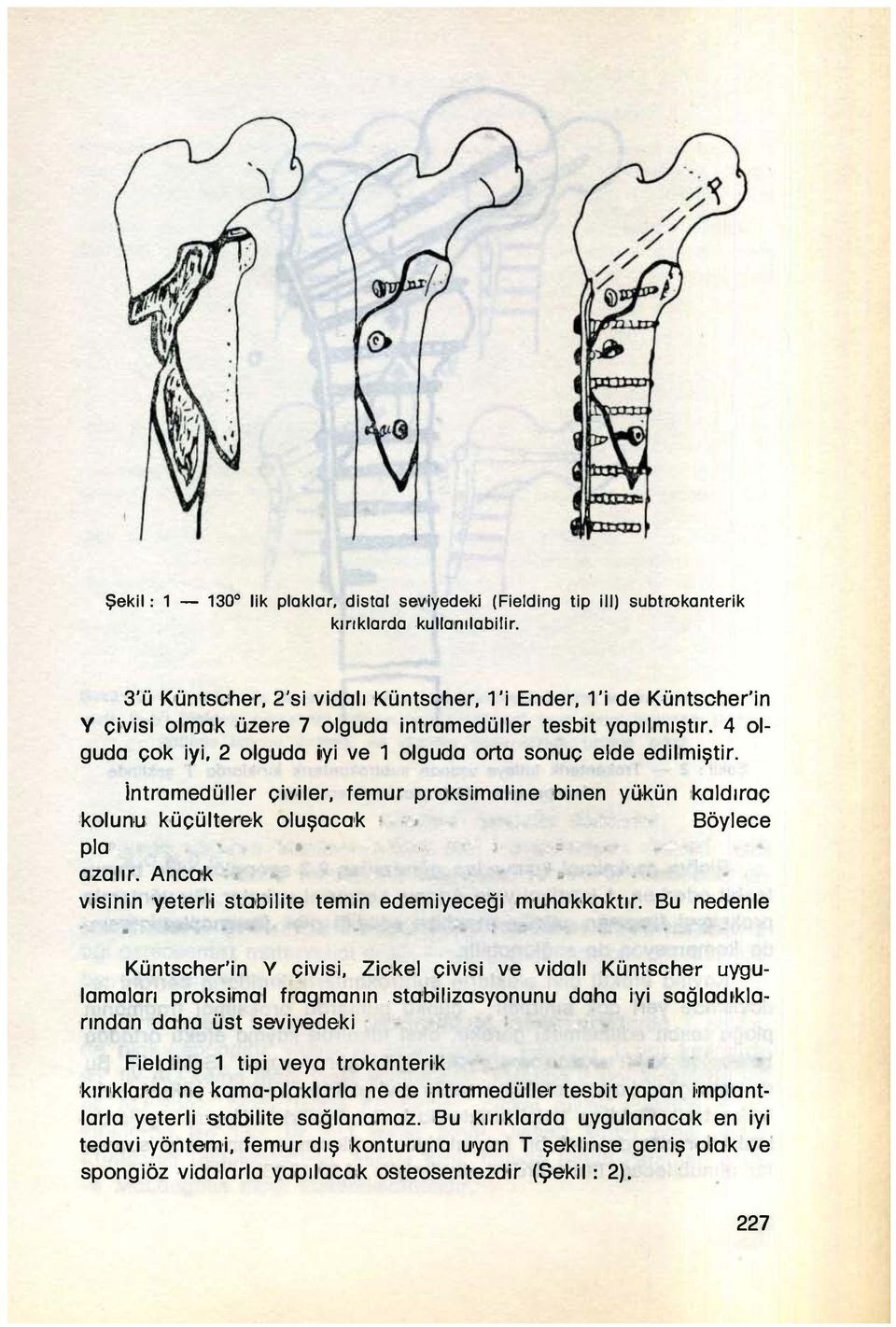 4 olguda çok iyi, 2 olguda iryi ve 1 olguda orta sonuç elde edilmiştir. intramedüller çiviler, femur proksimaline binen yükün :kaldıraç,kolunu küçülterek oluşaca'k : Böylece plai azalır.