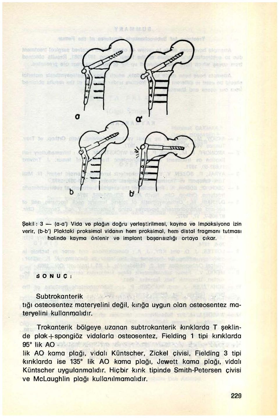 önlenir ve implant başarısızlığı ortaya çıkor. SONUC: Subtrokanteri:k tığı osteosentez materyelini değil, kırığa uygun olan osteosentez matei'yelini kullanmalıdlr.