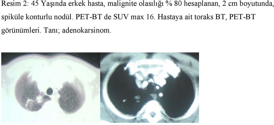 spiküle konturlu nodül. PET-BT de SUV max 16.