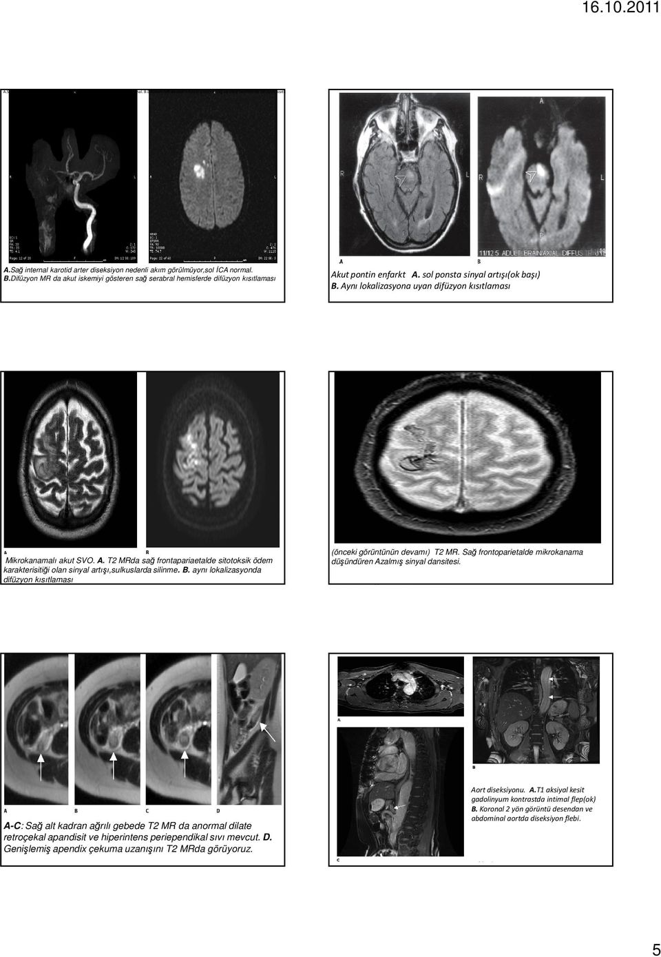 sol ponsta sinyal artışı(ok başı) B. Aynı lokalizasyona uyan difüzyon kısıtlaması Mikrokanamalı akut SVO. A. T2 MRda sağ frontapariaetalde sitotoksik ödem karakterisitiği olan sinyal artışı,sulkuslarda silinme.
