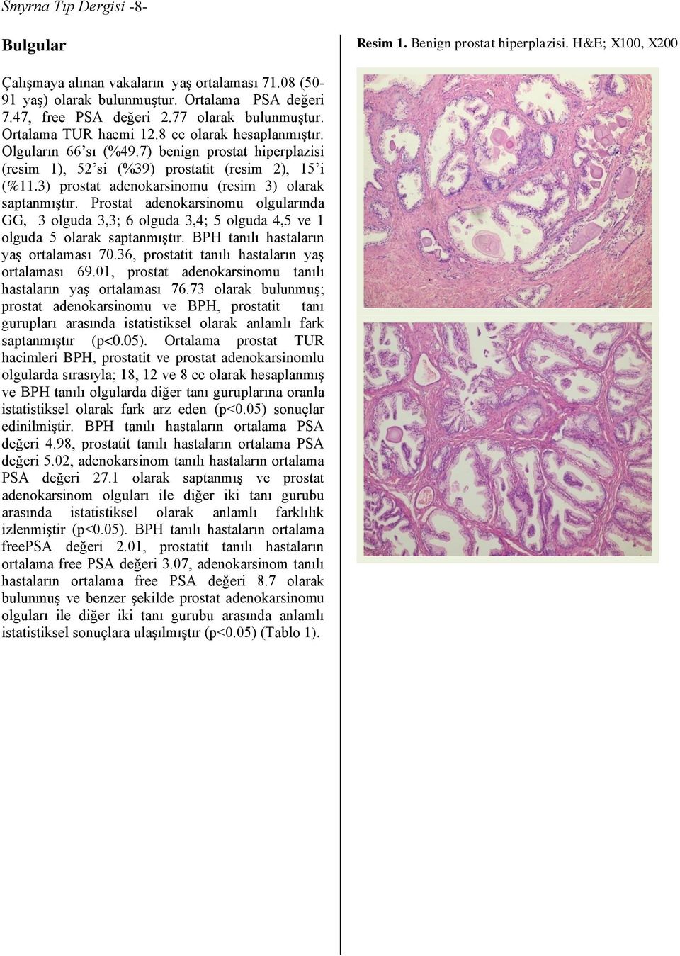 7) benign prostat hiperplazisi (resim 1), 52 si (%39) prostatit (resim 2), 15 i (%11.3) prostat adenokarsinomu (resim 3) olarak saptanmıştır.