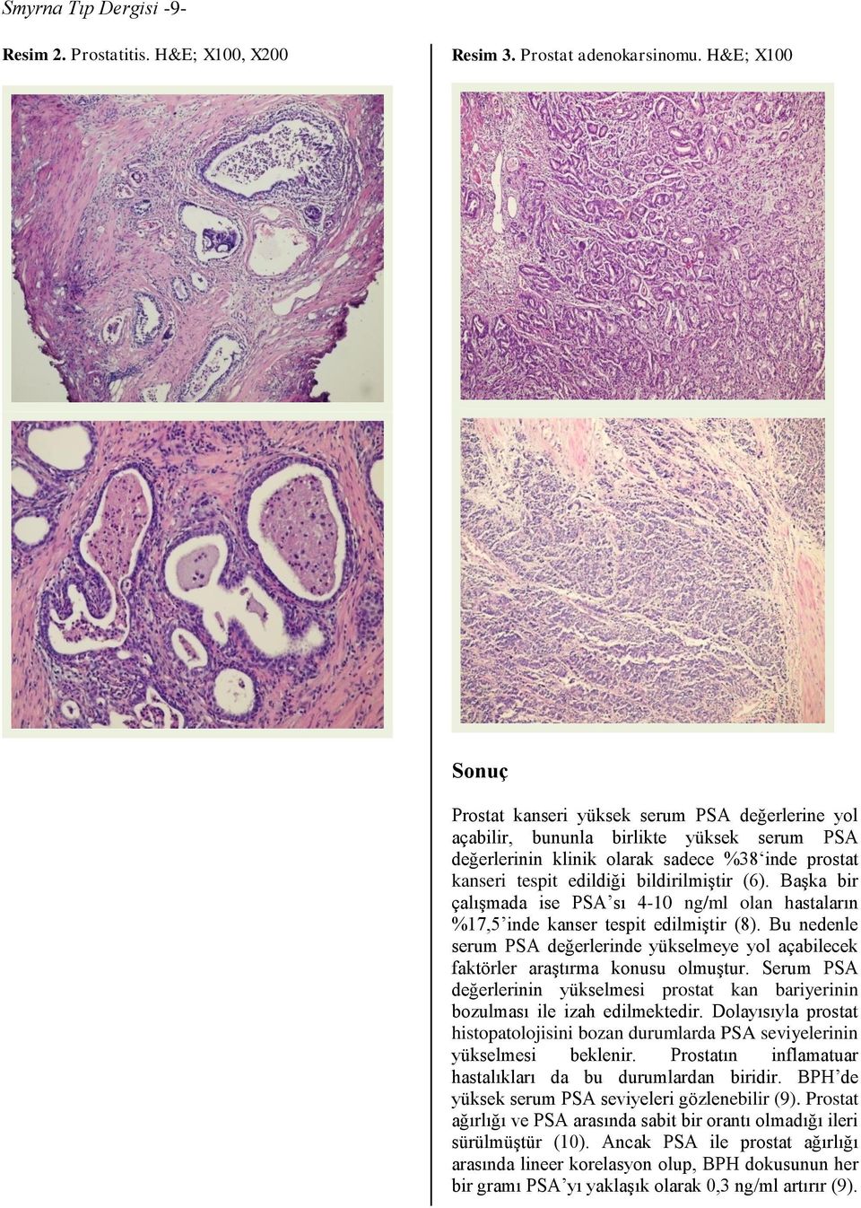 (6). Başka bir çalışmada ise PSA sı 4-10 ng/ml olan hastaların %17,5 inde kanser tespit edilmiştir (8). Bu nedenle serum PSA değerlerinde yükselmeye yol açabilecek faktörler araştırma konusu olmuştur.