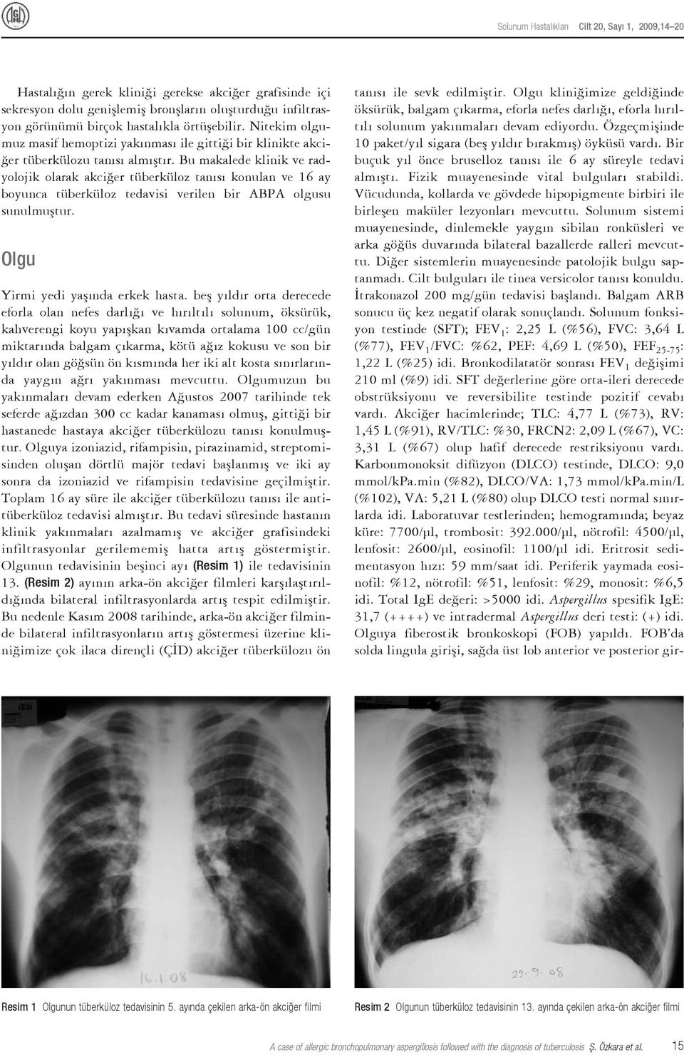 Bu makalede klinik ve radyolojik olarak akciğer tüberküloz tanısı konulan ve 16 ay boyunca tüberküloz tedavisi verilen bir ABPA olgusu sunulmuştur. Olgu Yirmi yedi yaşında erkek hasta.