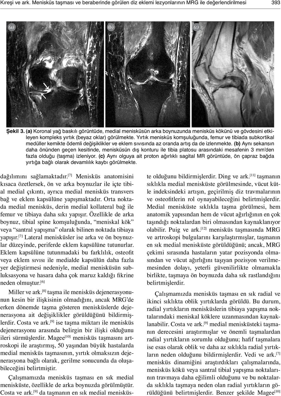 Yırtık menisküs komşuluğunda, femur ve tibiada subkortikal medüller kemikte ödemli değişiklikler ve eklem sıvısında az oranda artış da de izlenmekte.