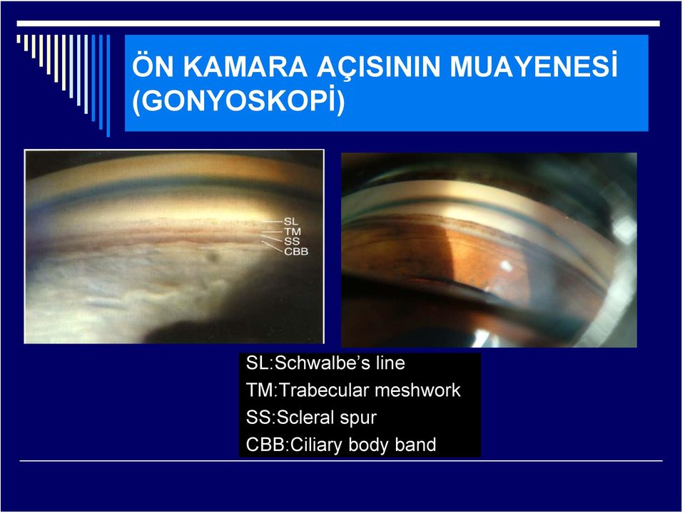 line TM:Trabecular meshwork