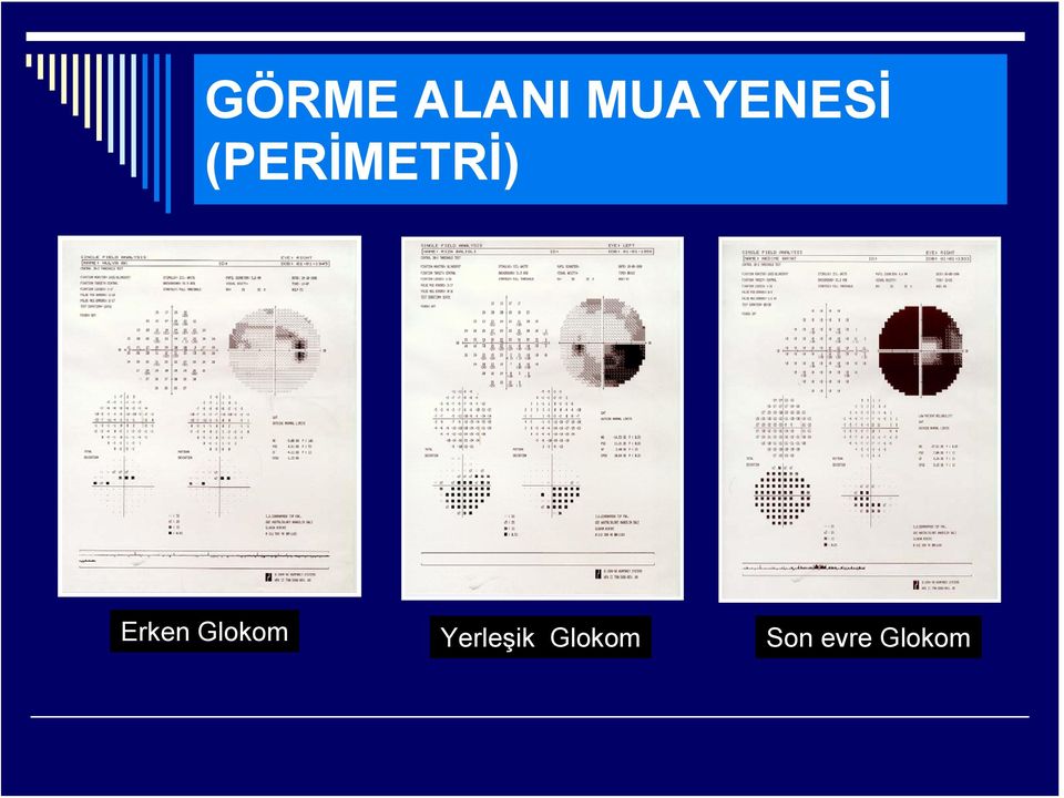 (PERİMETRİ) Erken