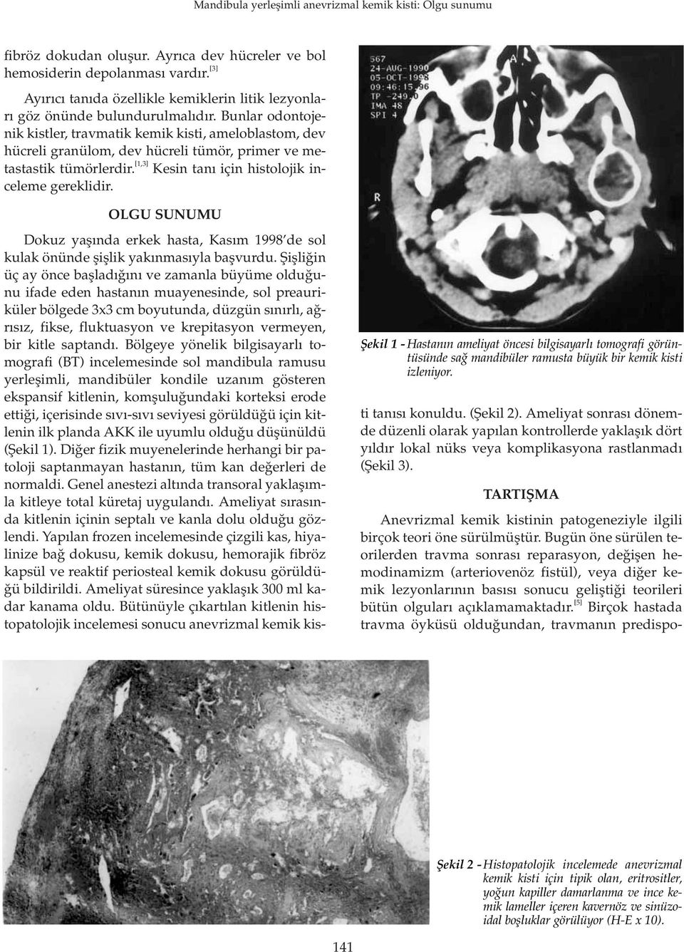 OLGU SUNUMU fiekil 1 - Hastan n ameliyat öncesi bilgisayarl tomografi görüntüsünde sa mandibüler ramusta büyük bir kemik kisti izleniyor.