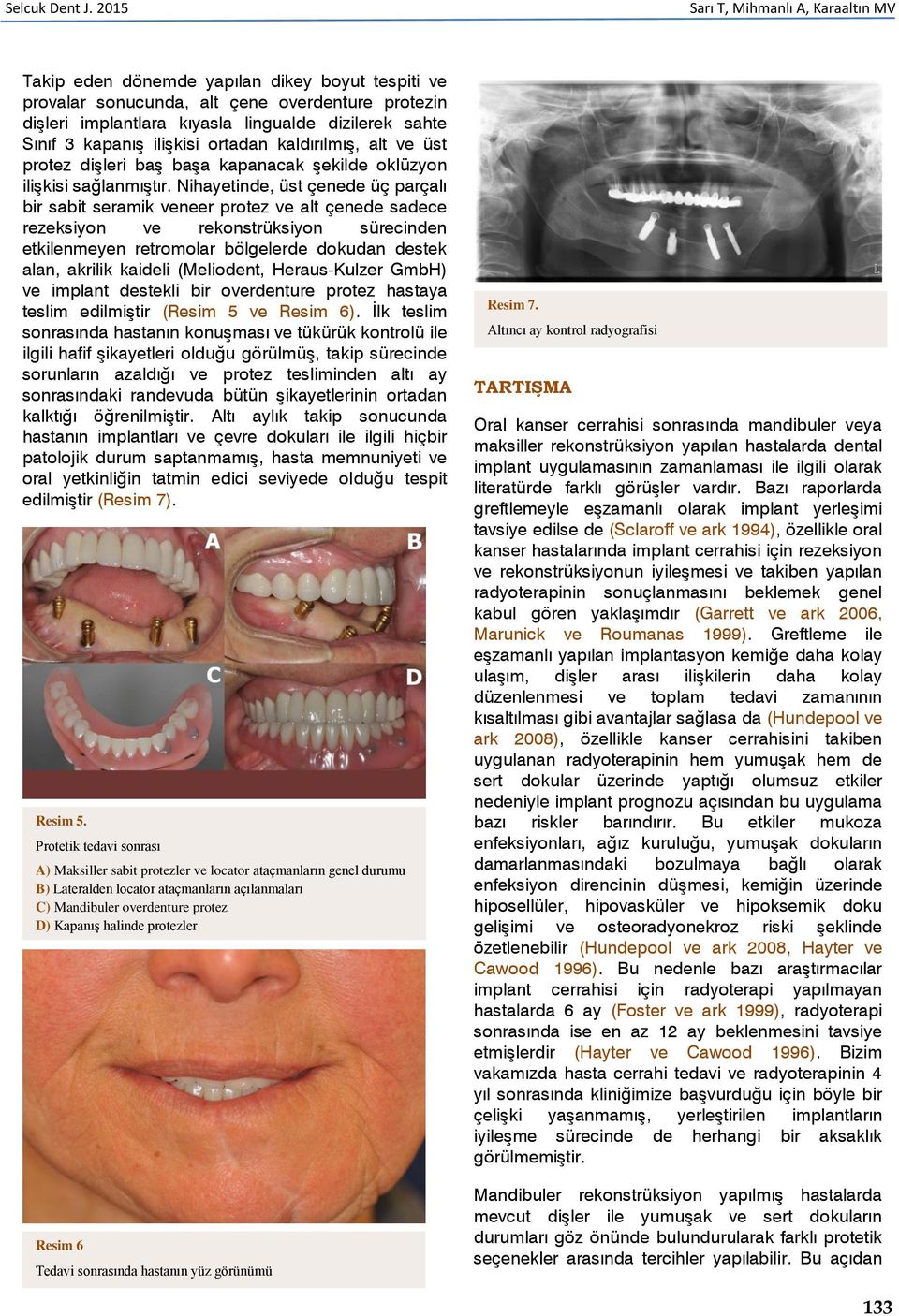 kapanış ilişkisi ortadan kaldırılmış, alt ve üst protez dişleri baş başa kapanacak şekilde oklüzyon ilişkisi sağlanmıştır.