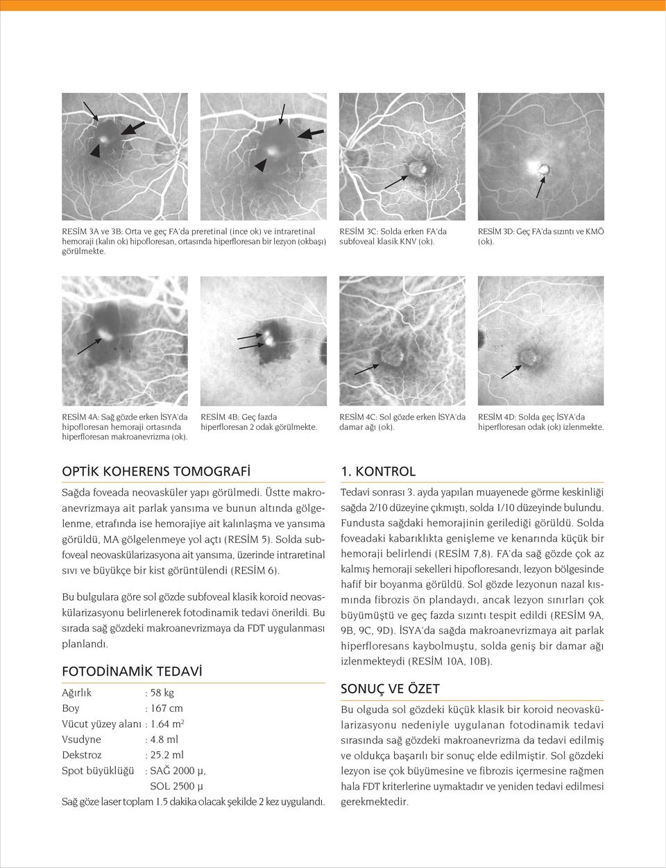 RES M 4B: Geç fazda hiperfloresan 2 odak görülmekte. RES M 4C: Sol gözde erken SYA'da damar a (ok). RES M 4D: Solda geç SYA'da hiperfloresan odak (ok) izlenmekte.