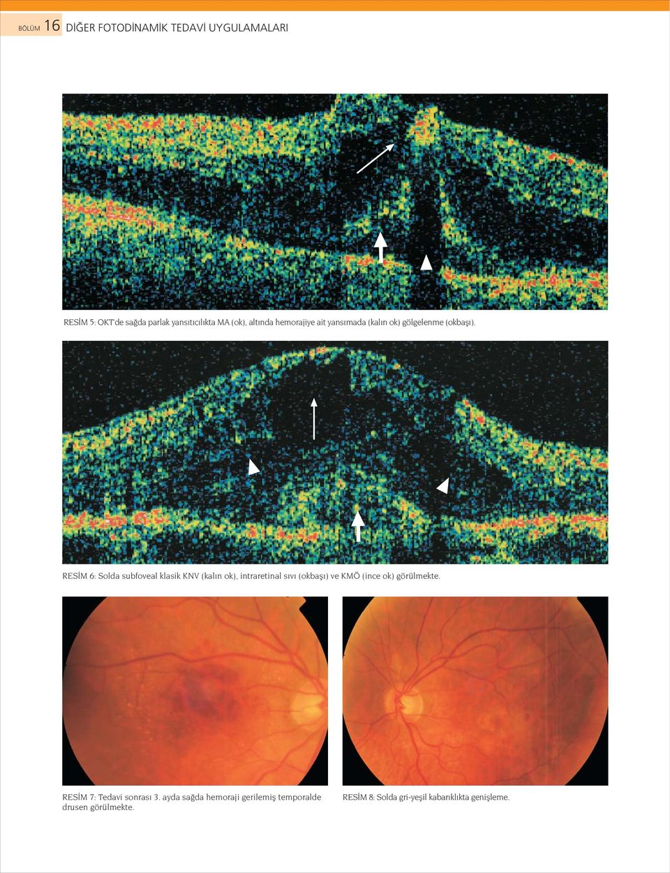 RES M 6: Solda subfoveal klasik KNV (kal n ok), intraretinal s v (okbafl ) ve KMÖ (ince ok)