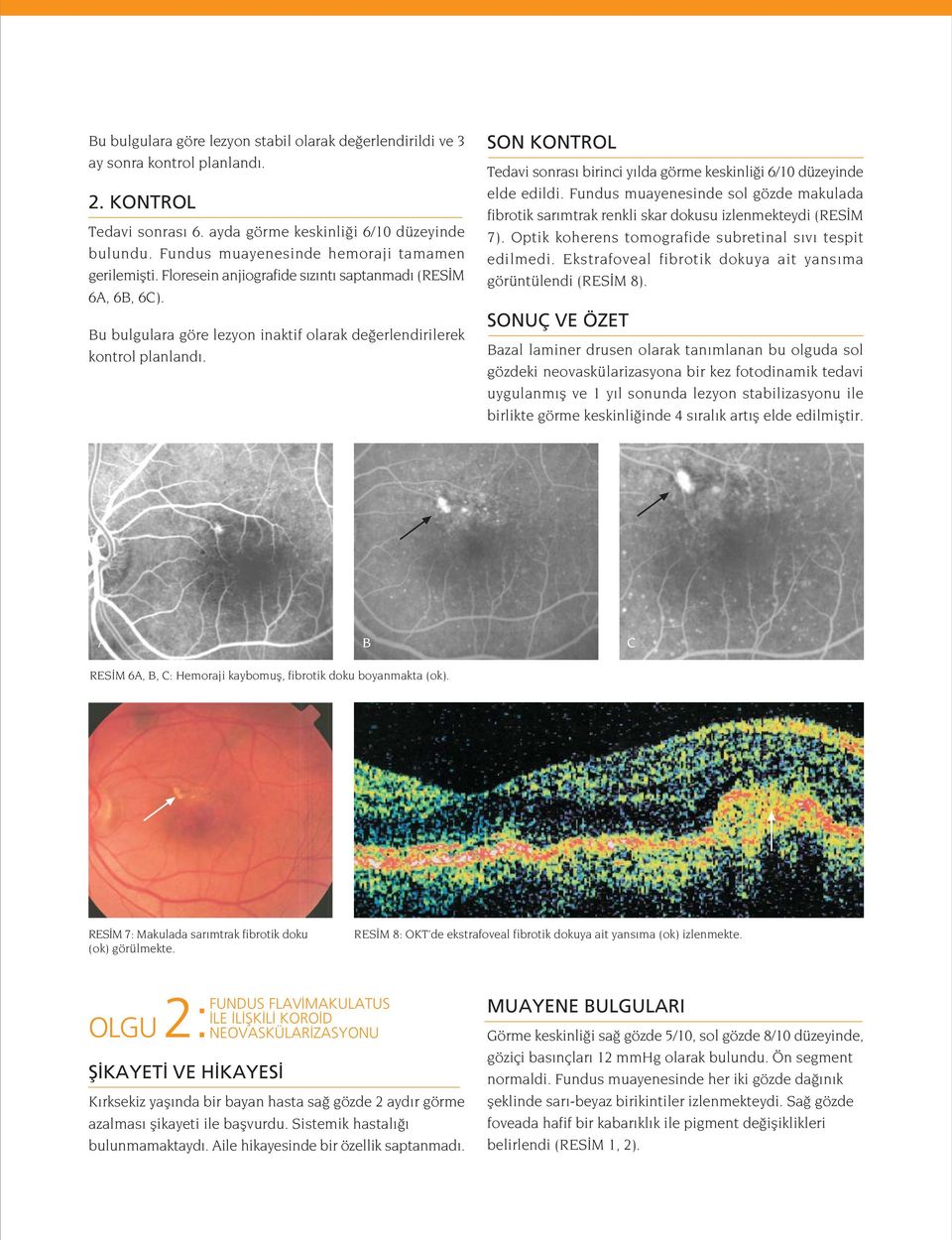 SON KONTROL Tedavi sonras birinci y lda görme keskinli i 6/10 düzeyinde elde edildi. Fundus muayenesinde sol gözde makulada fibrotik sar mtrak renkli skar dokusu izlenmekteydi (RES M 7).