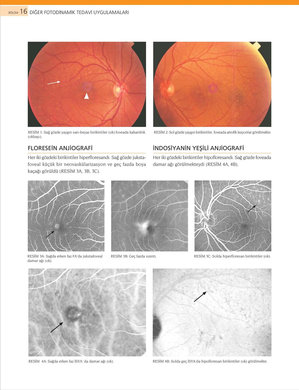 RES M 2: Sol gözde yayg n birikintiler, foveada atrofik lezyonlar görülmekte. NDOS YAN N YEfi L ANJ OGRAF Her iki gözdeki birikintiler hipofloresand.