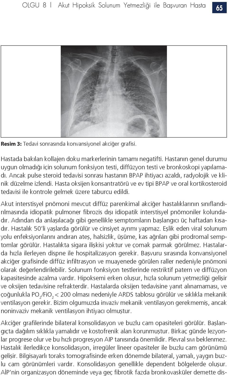 Ancak pulse steroid tedavisi sonrası hastanın BPAP ihtiyacı azaldı, radyolojik ve klinik düzelme izlendi.