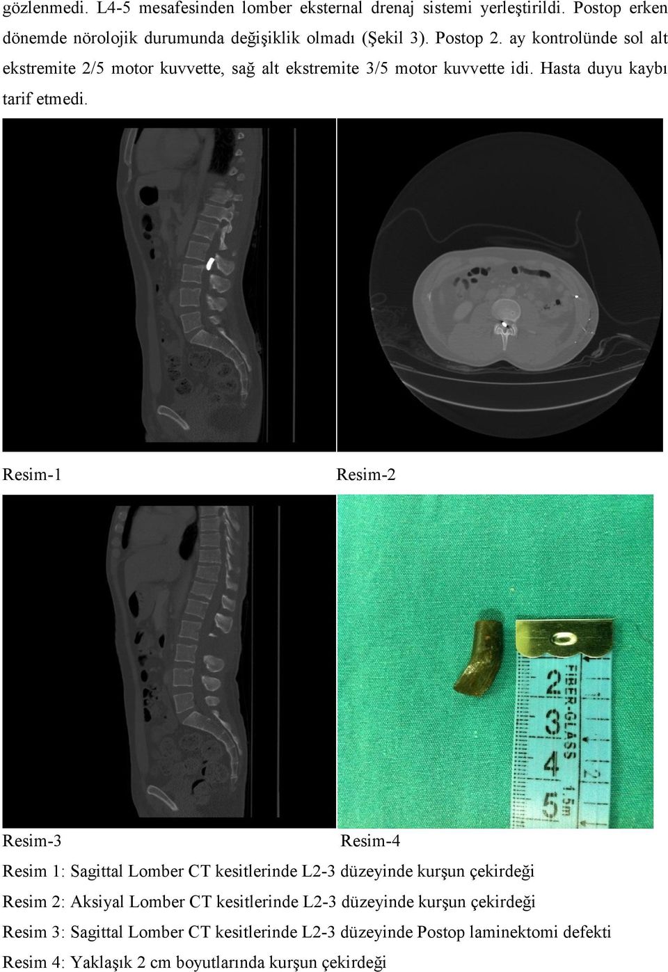 Resim-1 Resim-2 Resim-3 Resim-4 Resim 1: Sagittal Lomber CT kesitlerinde L2-3 düzeyinde kurşun çekirdeği Resim 2: Aksiyal Lomber CT kesitlerinde L2-3