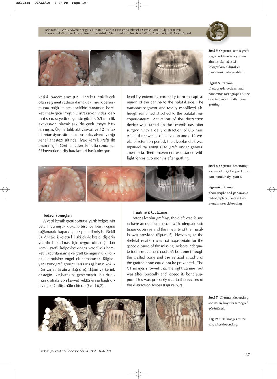 Intraoral photograph, occlusal and kesisi tamamlanm flt r. Hareket ettirilecek olan segment sadece damaktaki mukoperios-teuma ba l kalacak flekilde tamamen hare-ketli hale getirilmifltir.