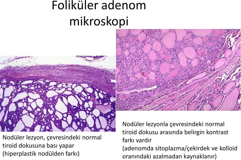 çevresindeki normal tiroid dokusu arasında belirgin kontrast farkı