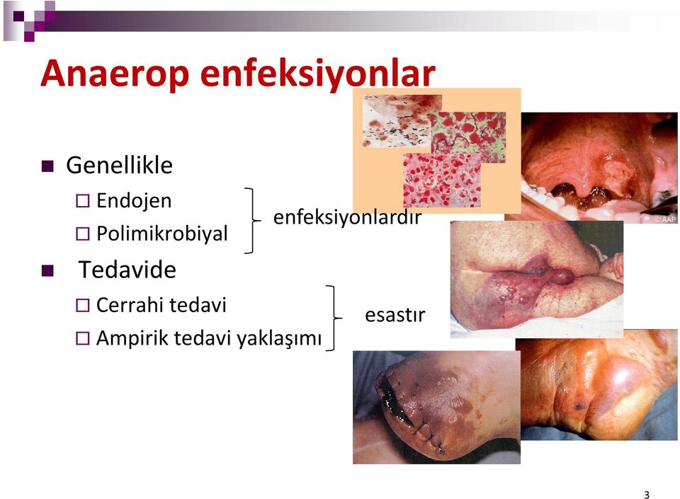 Polimikrobiyal Tedavide Cerrahi