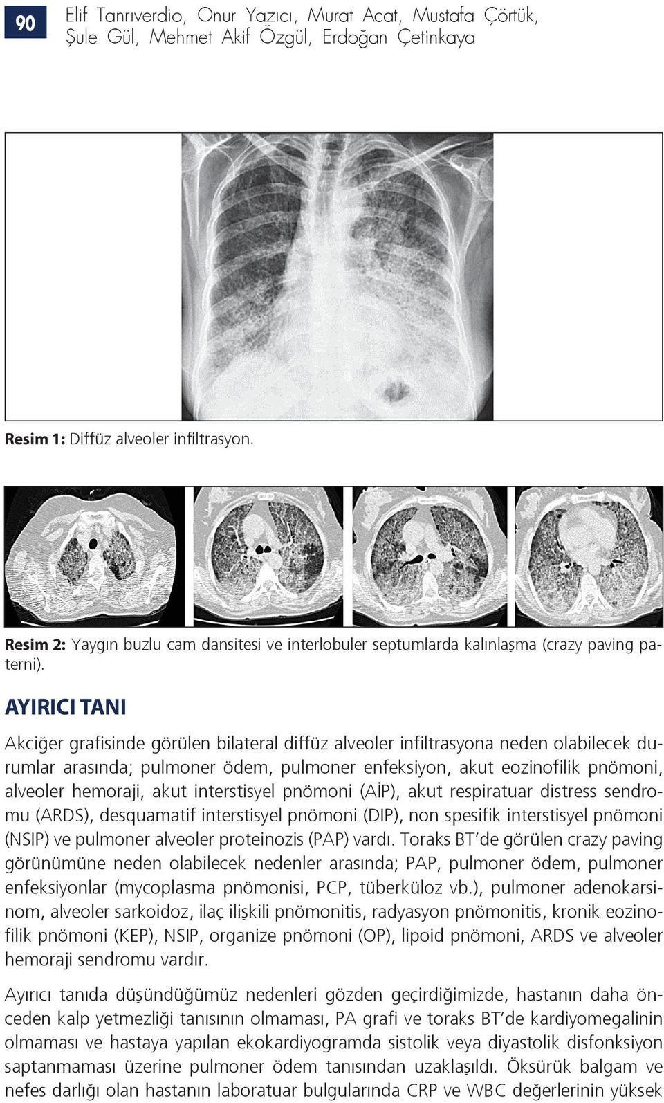 AYIRICI TANI Akciğer grafisinde görülen bilateral diffüz alveoler infiltrasyona neden olabilecek durumlar arasında; pulmoner ödem, pulmoner enfeksiyon, akut eozinofilik pnömoni, alveoler hemoraji,