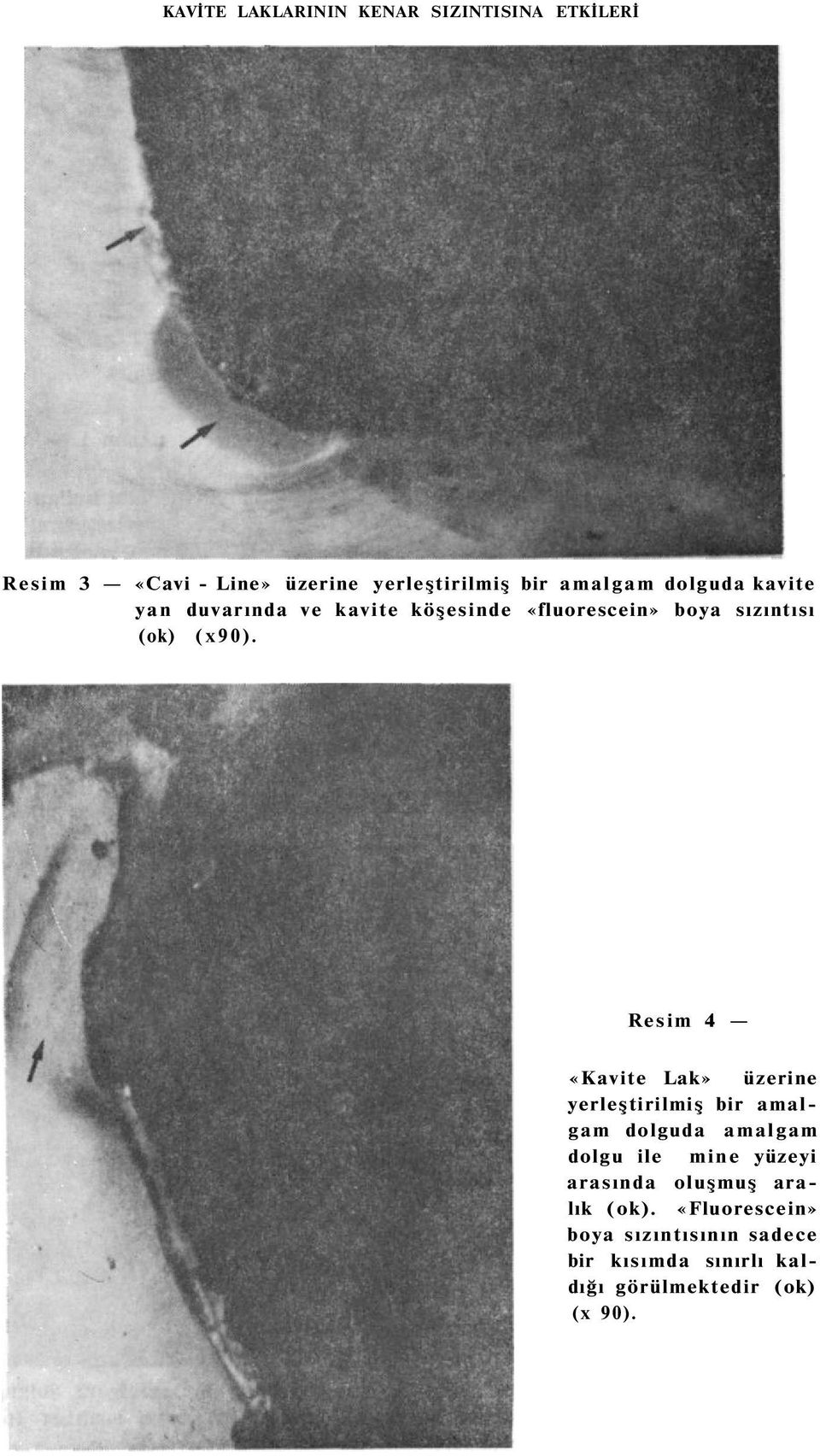 Resim 4 «Kavite Lak» üzerine yerleştirilmiş bir amalgam dolguda amalgam dolgu ile mine yüzeyi arasında