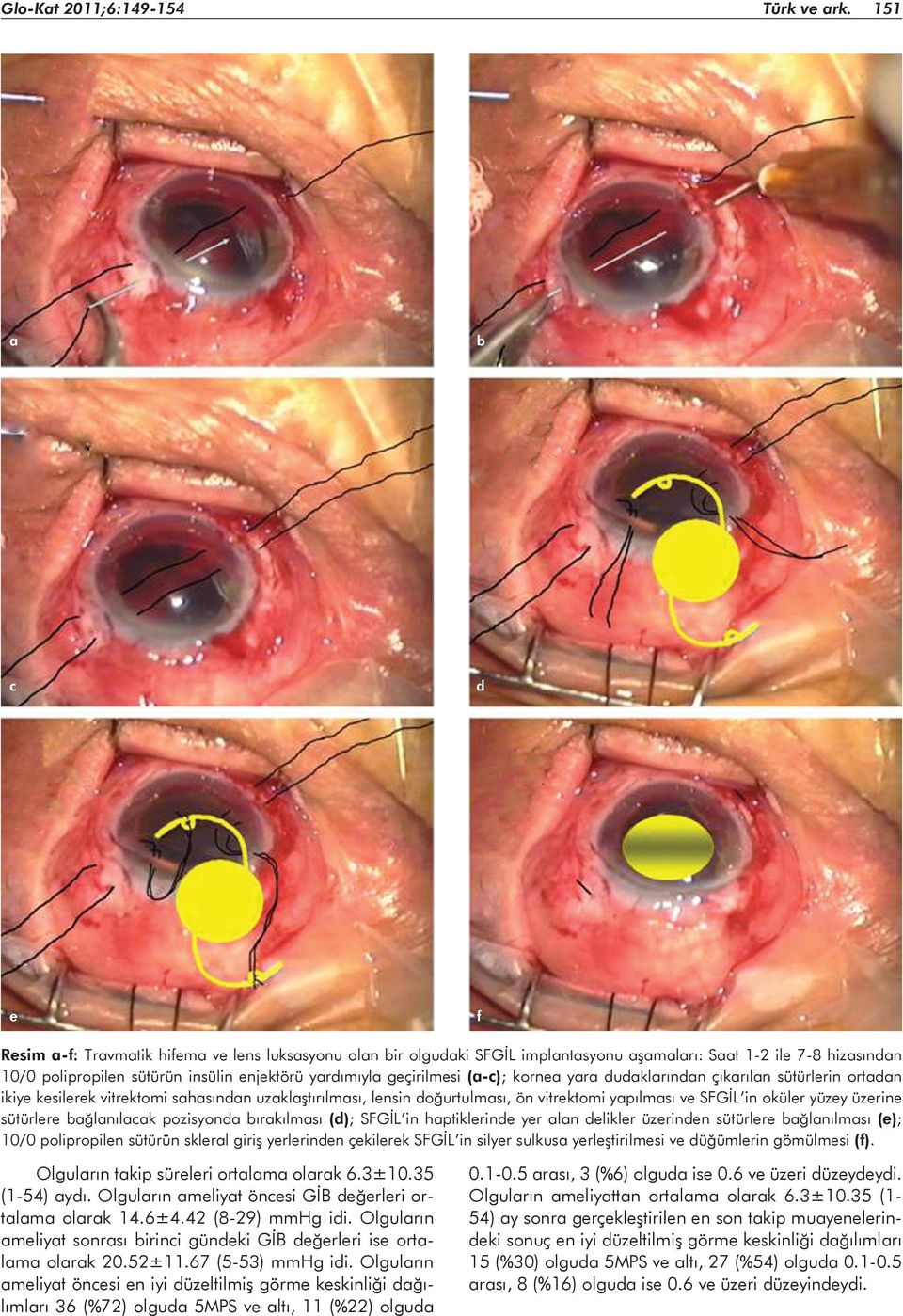 geçirilmesi (a-c); kornea yara dudaklarından çıkarılan sütürlerin ortadan ikiye kesilerek vitrektomi sahasından uzaklaştırılması, lensin doğurtulması, ön vitrektomi yapılması ve SFGİL in oküler yüzey