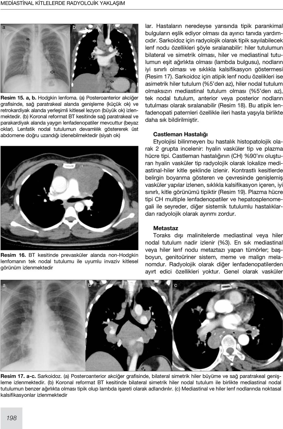 Lenfatik nodal tutulumun devamlılık göstererek üst abdomene doğru uzandığı izlenebilmektedir (siyah ok) Resim 16.