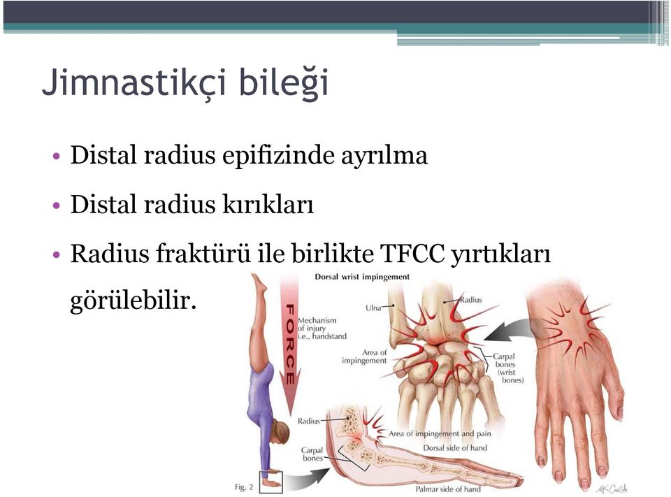 kırıkları Radius fraktürü ile