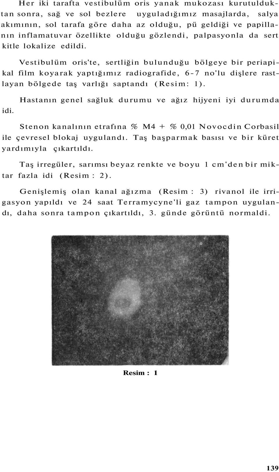 Vestibulüm oris'te, sertliğin bulunduğu bölgeye bir periapikal film koyarak yaptığımız radiografide, 6-7 no'lu dişlere rastlayan bölgede taş varlığı saptandı (Resim: 1). idi.