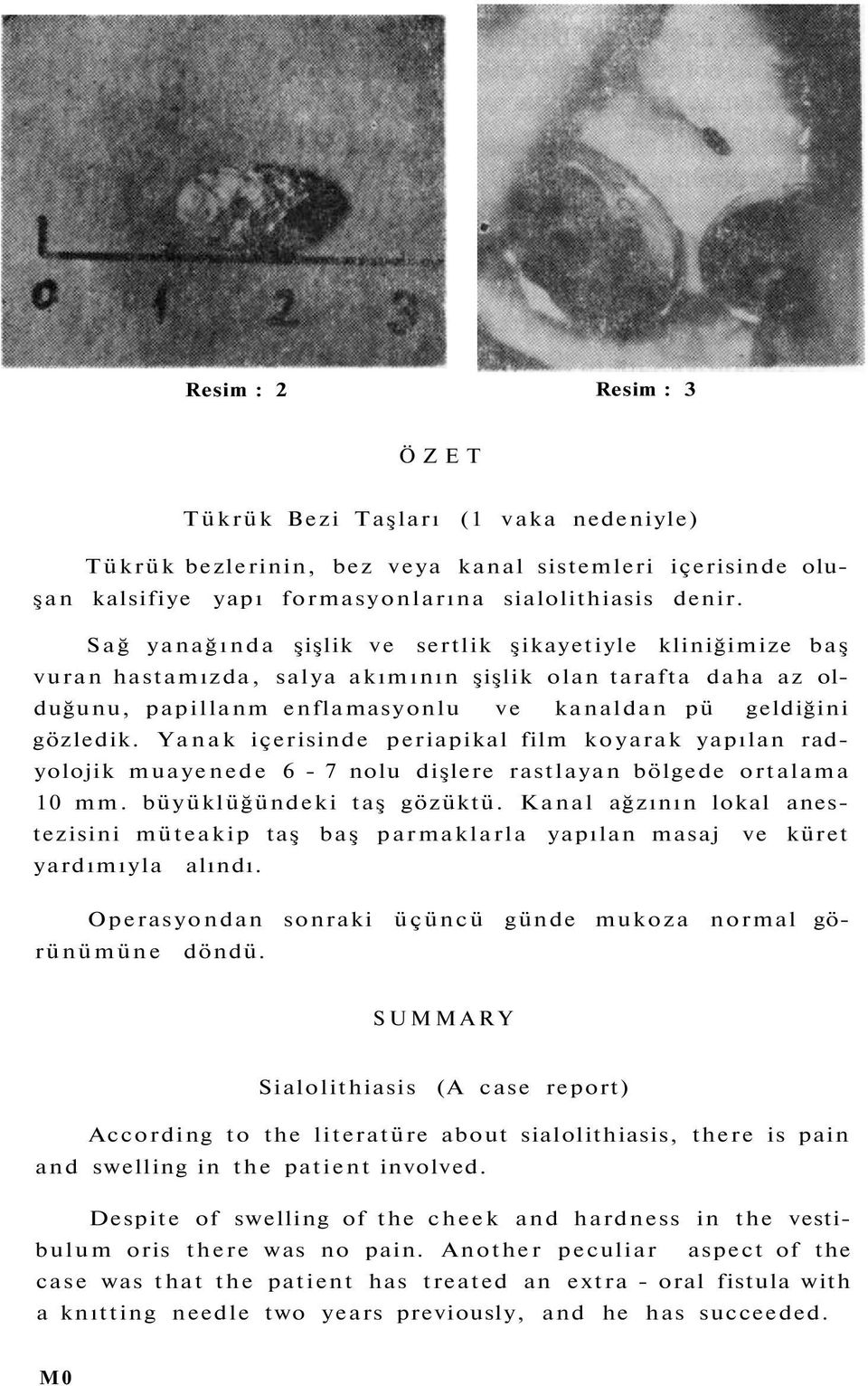 Yanak içerisinde periapikal film koyarak yapılan radyolojik muayenede 6-7 nolu dişlere rastlayan bölgede ortalama 10 mm. büyüklüğündeki taş gözüktü.