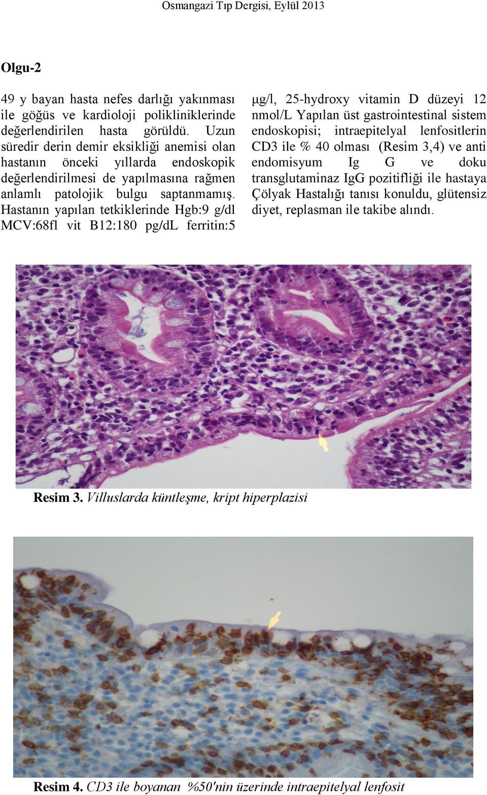 Hastanın yapılan tetkiklerinde Hgb:9 g/dl MCV:68fl vit B12:180 pg/dl ferritin:5 μg/l, 25-hydroxy vitamin D düzeyi 12 nmol/l Yapılan üst gastrointestinal sistem endoskopisi; intraepitelyal