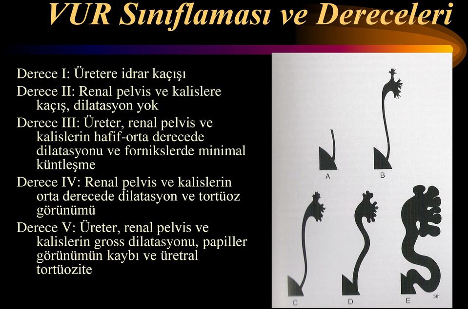 fornikslerde minimal küntleşme Derece IV: Renal pelvis ve kalislerin orta derecede dilatasyon ve tortüoz