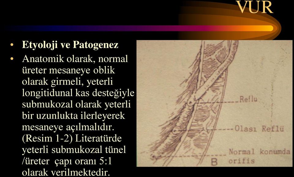 yeterli bir uzunlukta ilerleyerek mesaneye açılmalıdır.