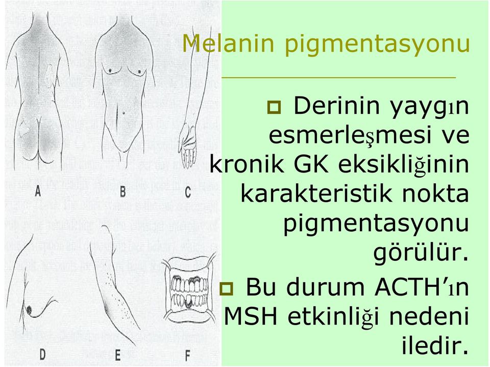 karakteristik nokta pigmentasyonu