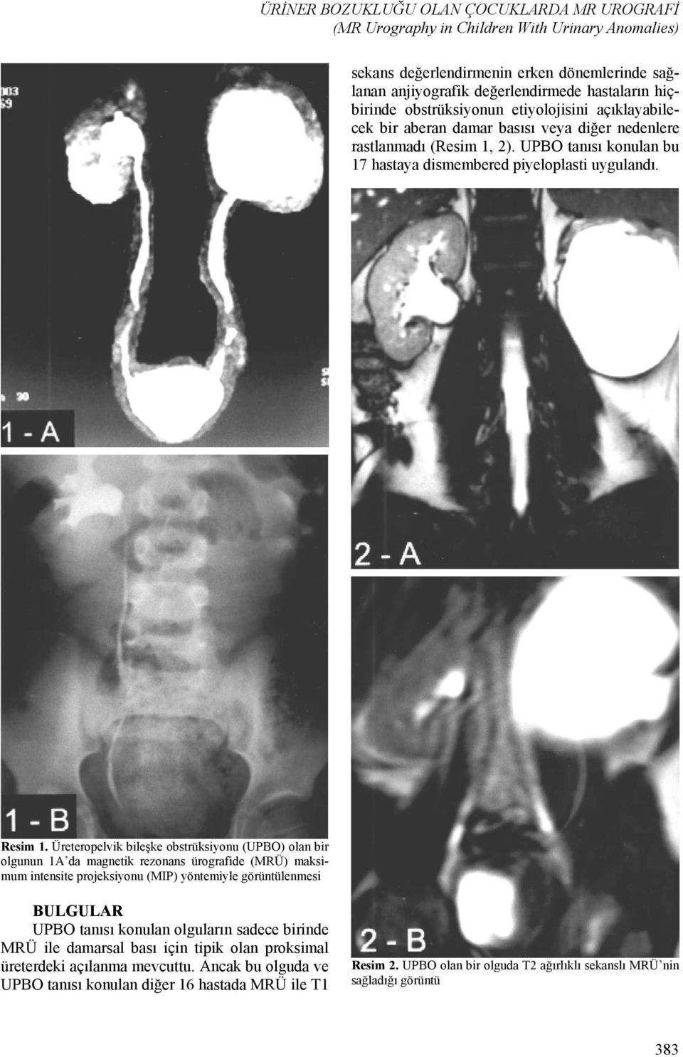 Üreteropelvik bileşke obstrüksiyonu (UPBO) olan bir olgunun 1A da magnetik rezonans ürografide (MRÜ) maksimum intensite projeksiyonu (MIP) yöntemiyle görüntülenmesi BULGULAR UPBO tanısı konulan