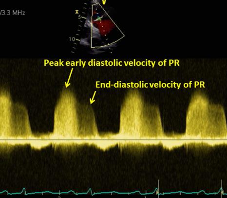 DOPPLER EKO ve Hemodinamik değerlendirme ORTALAMA PULMONER ARTER BASINCI mpap=