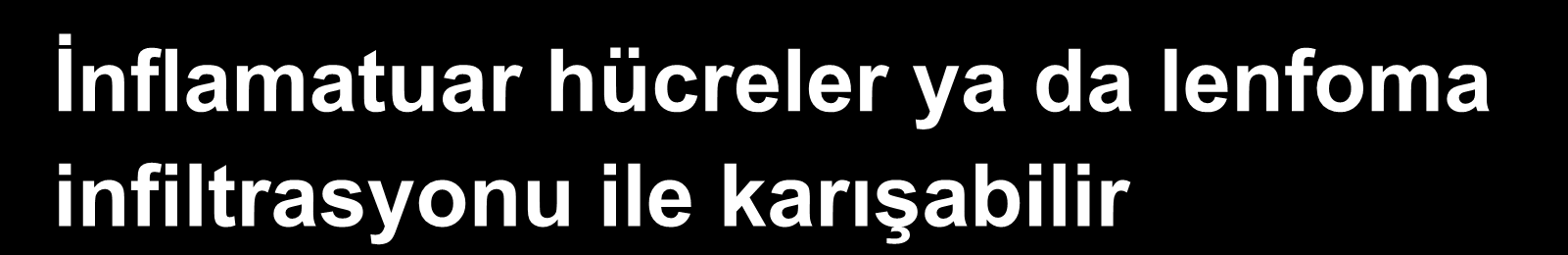 Taşlı Yüzük Hücreli Karsinom Müsin içermeyen küçük hücreli tip İnflamatuar hücreler ya da