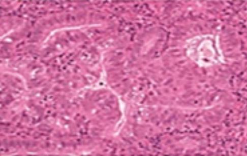 Kompleks hiperplazi Kompleks atipili sdlfsdlk hiperplazi Closely packed glands Stroma sparse G/S ratio >2 Nuclei uniform oval Nucleoli